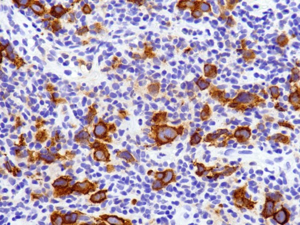 cd30 经典型霍奇金淋巴瘤rs细胞阳性表达