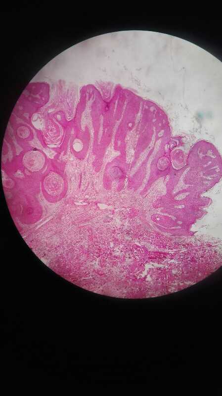 皮内痣病理图片图片