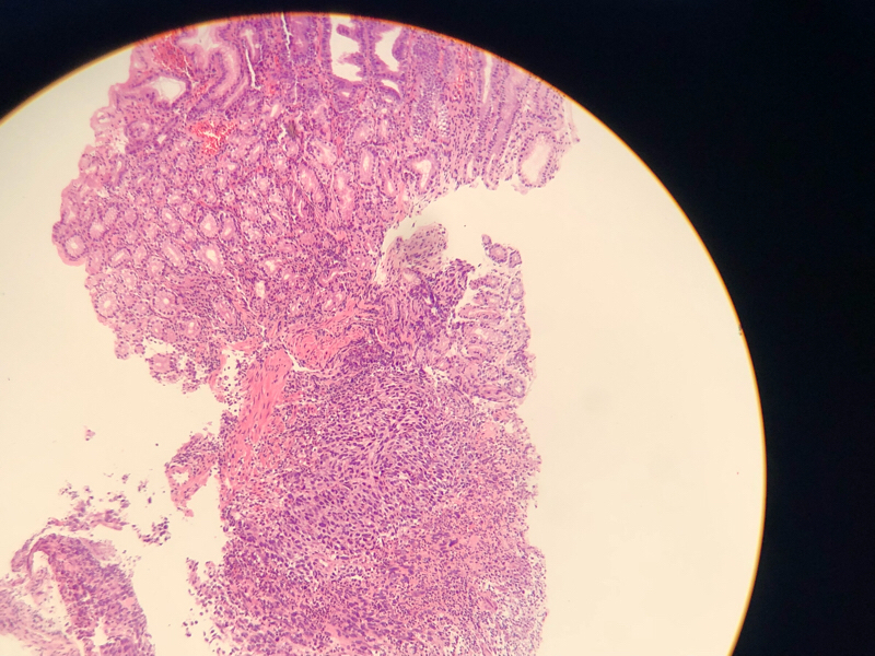 胃溃疡显微镜下图片图片