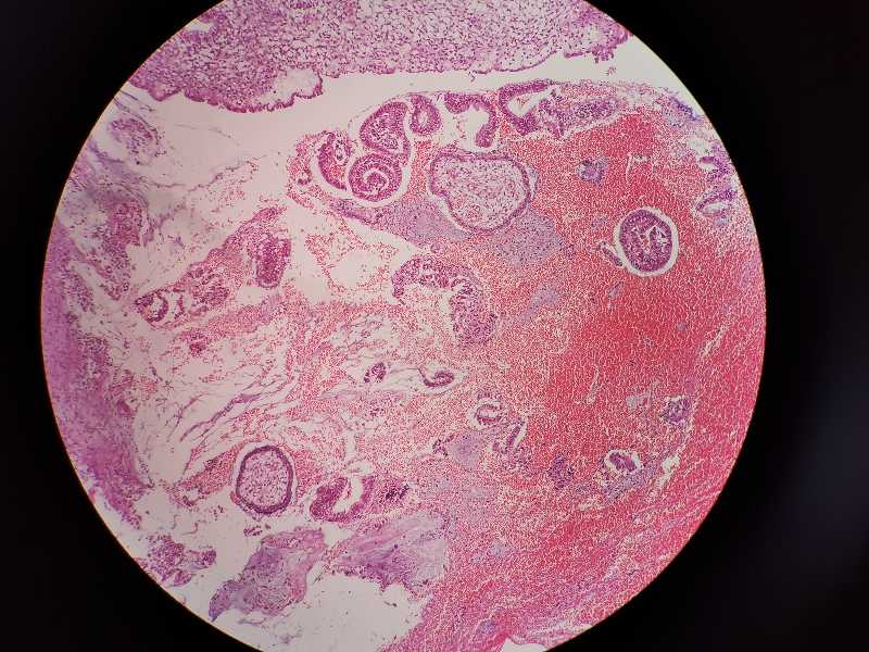 绒毛膜癌病理图片图片