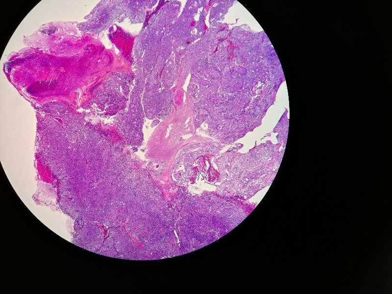 子宫内膜癌诊刮物图片图片