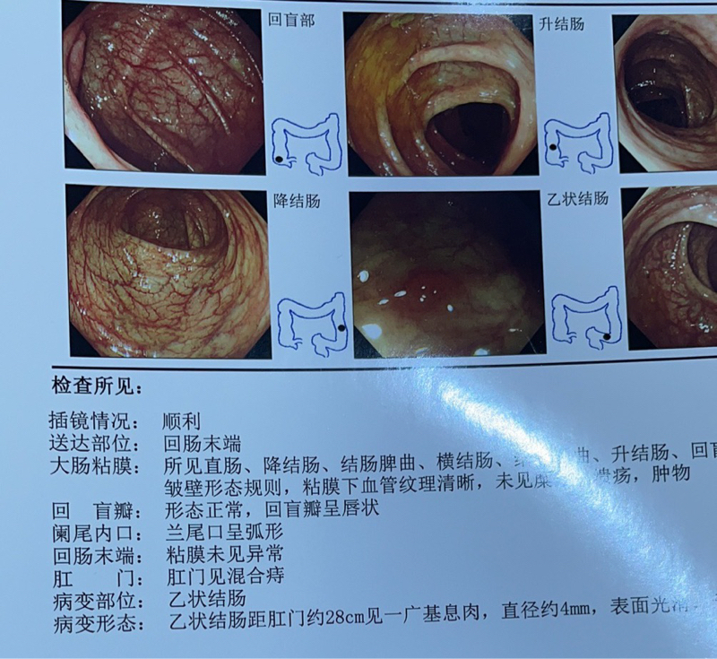 结肠腺瘤严重吗图片